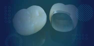 Porcelain Fused to Metal Crown